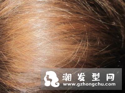 头皮屑为什么越抓越多 又多又大怎么办