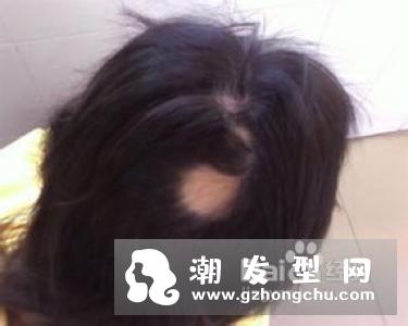 染发会导致脱发吗 脱发怎么办