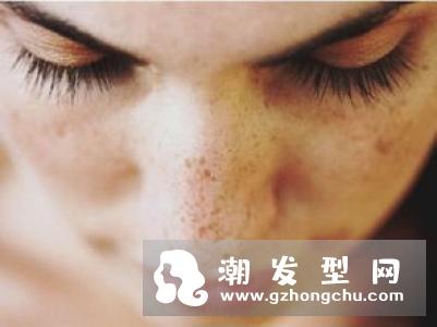 蝴蝶斑激光能去掉吗 会疼吗