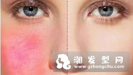 洗面奶过敏有什么症状 加白糖洗脸好吗