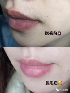 脱毛膏能脱胡子吗 用了后红疼怎么办