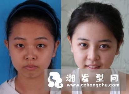 发际线调整靠谱吗 发际线低适合什么发型
