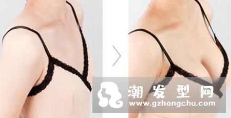 自体脂肪丰胸成活率是多少 哪里脂肪多