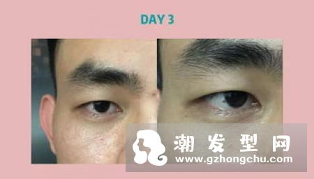 木瓜膏可以去黑眼圈吗 方法是怎样的