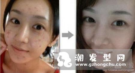 用白糖水擦痘印有用吗 有什么作用