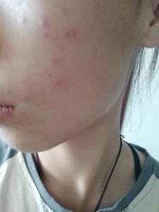 头发油吃什么好 长疙瘩怎么办