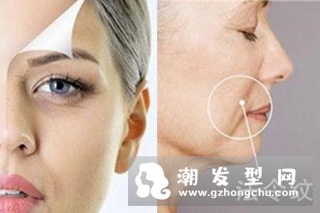 维生素e可以消除法令纹吗 怎么消除