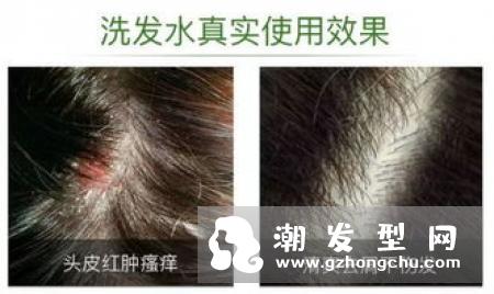头皮屑为什么越抓越多 又多又大怎么办