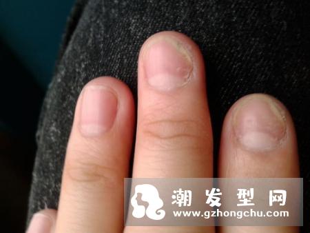 软指甲是怎么回事 是缺什么元素