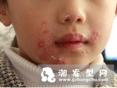 嘴唇上长泡可以涂芦荟胶吗 怎么涂