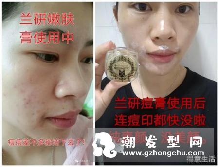 曼秀雷敦祛痘膏有用吗 怎么使用