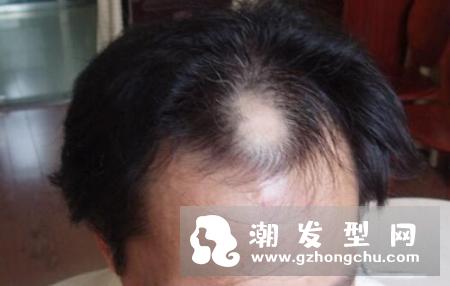 头发出油是什么原因 会脱发吗及怎么办