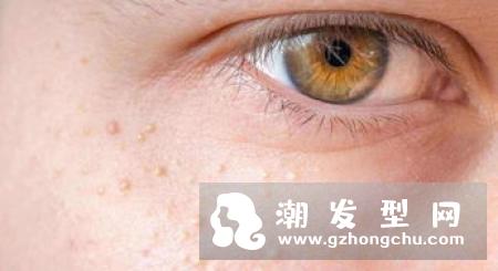 用完法国珍贵水后续用什么 怎么去闭口粉刺