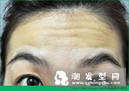 抬头纹是什么 是怎么产生的