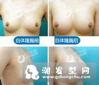 自体脂肪丰胸多久恢复 多久消肿