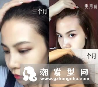 头发稀少怎么办 生姜擦头好吗