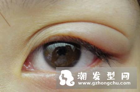戴隐形眼镜充血怎么办 用冷毛巾怎么敷