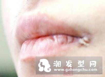 嘴唇上长泡可以涂芦荟胶吗 怎么涂