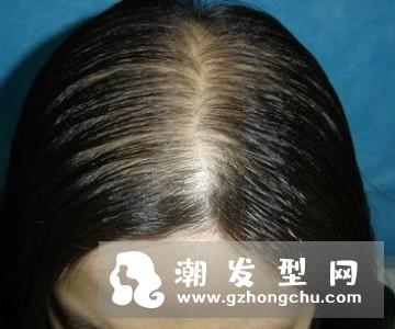 染发会导致脱发吗 脱发怎么办