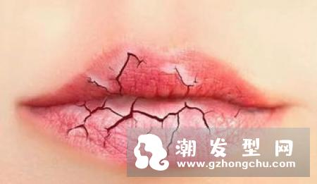 嘴唇上长泡烂了怎么办 会传染吗