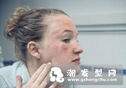 染发剂过敏症状 怎么办