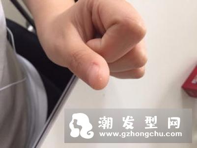 20岁脱发严重怎么办 夏季还是冬季脱发严重