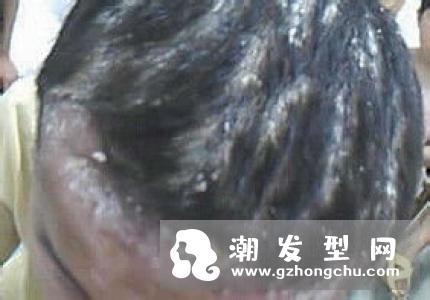 头屑突然增多是什么原因 头上有大块头皮屑怎么办