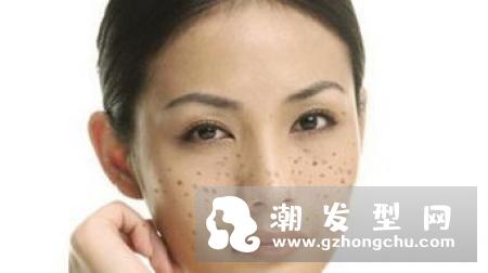 蝴蝶斑激光能去掉吗 会疼吗
