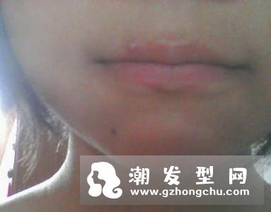 嘴唇上长泡可以涂红霉素软膏吗 怎么涂