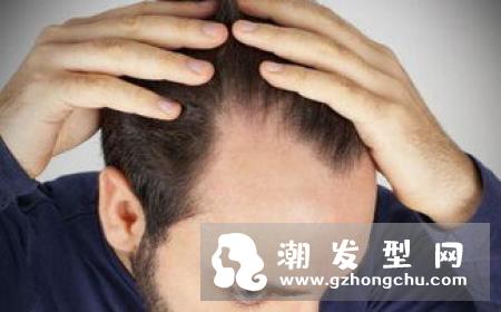脱发都遗传吗 有压力会掉头发吗