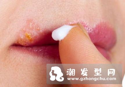 嘴唇上长泡多久能好 需要治疗吗