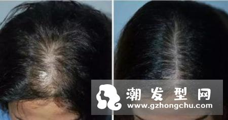 头发越洗越油还是越洗越干 爱出油是缺水吗
