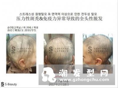 脱发都遗传吗 有压力会掉头发吗