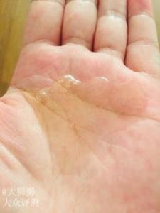 吸烟会引起脱发吗 有头皮屑用什么洗发水