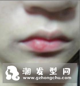 嘴唇上长泡多久能好 需要治疗吗